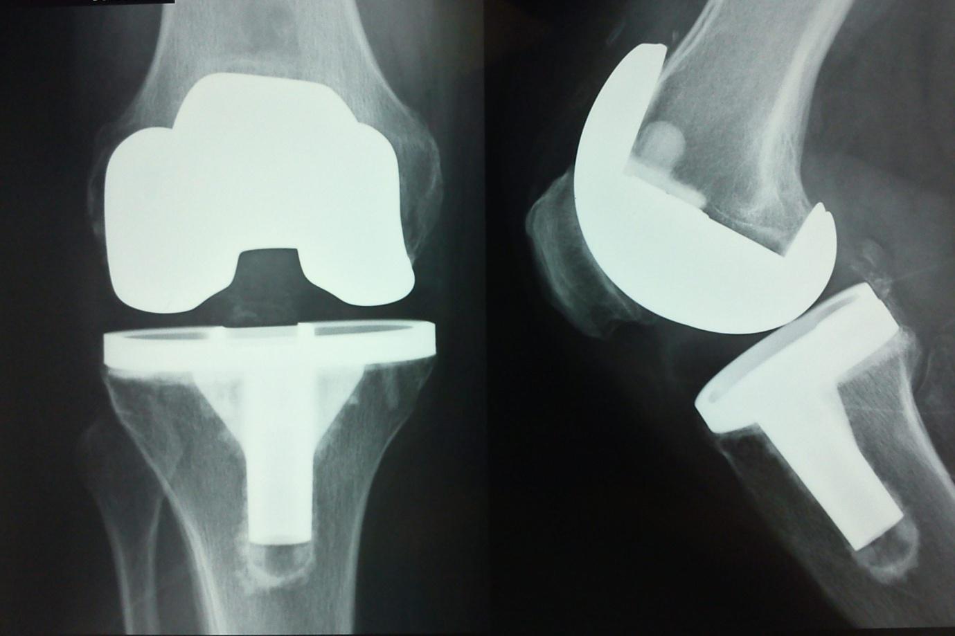 An Alarming Number of Knee Replacement Surgeries Deemed